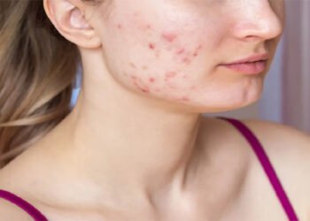 मानसून में मुंहासों की समस्या से हैं परेशान, यह रहा हल